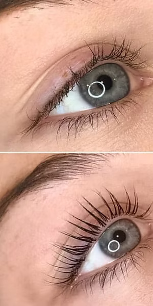 depilación láser segura en centro de estética